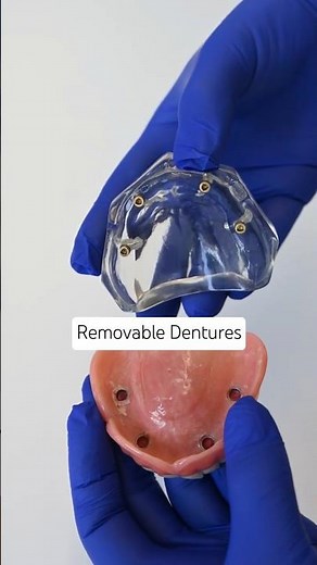 How Removable Snap-On Dentures Actually Work