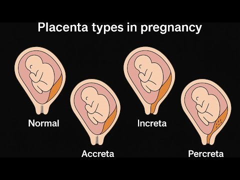 Placenta Types in pregnancy!Accreta!increta!percreta!Importance of Placental position#baby#radiology
