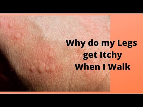 Why do my Legs get Itchy When I Walk