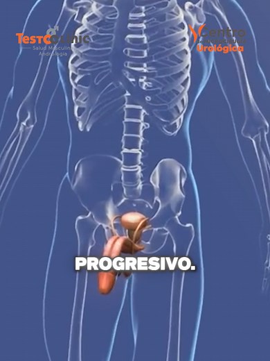 Varicocele: Cuida Tu Salud Masculina