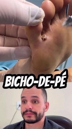 Bicho-de-pé: Sintomas e Tratamento do Parasita
