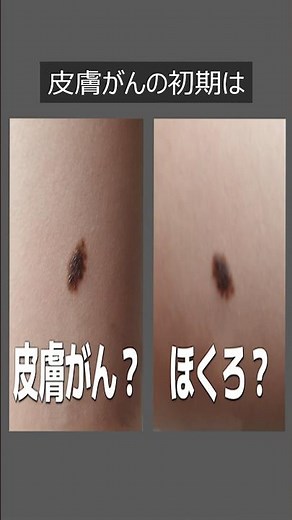 体にこんな「ほくろ」があったら「皮膚がん」です（今すぐ確認してください）