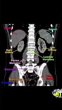 ANATOMIA ABDOMINAL EN TOMOGRAFIA (CORTE CORONAL, ESPAÑOL/INGLES).