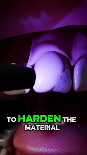 What Happens When a Dentist Fixes a Chipped Tooth? 🦷✨