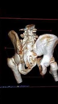 3D CT scan Hip joint
