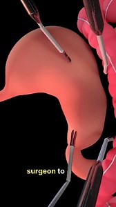 42K views · 236 reactions | sleeve gastrectomy surgery #reelschallenge #viralshorts #viralchallenge #hilights #trend #virals #short #trendingreel | Nursing Job Circular | Facebook