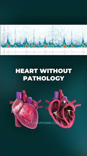 What Does a Normal Heart Sound Like?