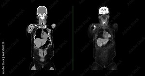 A PET-CT scan is a diagnostic imaging technique combining positron emission tomography (PET) and computed tomography (CT) in cancer diagnosis and staging.