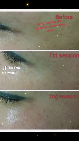 Happy to share that our micro needling results are outstanding and almost all our clients are happy and satisfied. Also, promo rate is still going on Get an appointment 👍