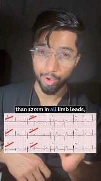 How To Read ECG || Every Medico Should Know These Basic ECG #ecg #medicalstudent