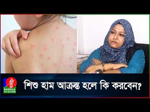 আপনার সন্তানের হাম হলে বুঝবেন কিভাবে?
