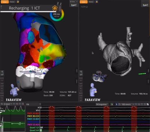 Dr Rythmo on Instagram: "C’est pour cela que je suis passionnée par la rythmologie interventionnelle ! ➡️La semaine dernière, lors d’une intervention mini-invasive de traitement du rythme cardiaque à l’Hôpital Américain de Paris, le patient a bénéficié d’une ablation de fibrillation atriale dans l’oreillette gauche par une technique d’électroporation 3D en ambulatoire. ➡️Le patient a présenté une deuxième arythmie de type flutter commun pendant l’intervention, nous avons donc poursuivi avec une 