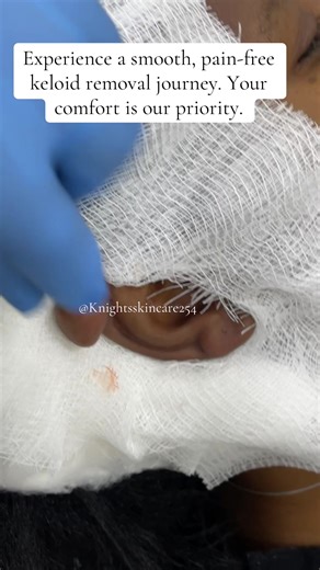 Keloid Removal Solutions for Confident Skin
