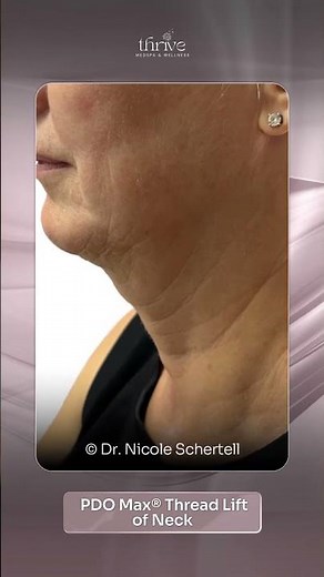 PDO Max® Thread Lift of Neck