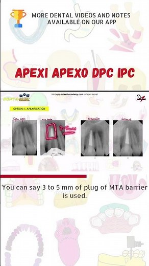 Apexification, Apexogenesis, DPC, IPC