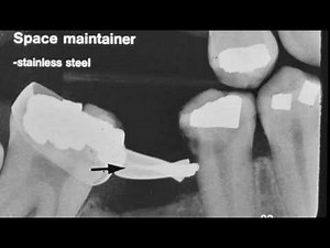 Dental Radiograph Pathology & Restorations • Video • MEDtube.net