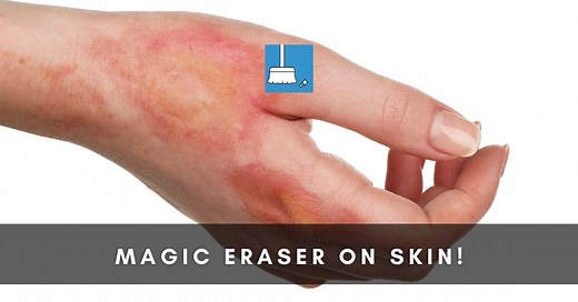 Magic Eraser On Skin! What To Do? (5 Steps!) »