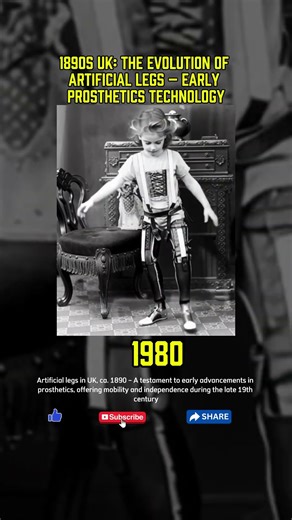 1890s UK: The Evolution of Artificial Legs – Early Prosthetics Technology
