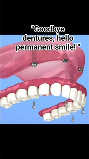 4Implants.1 Bridge.A lifetime of smiles. ✨Witness the magic of the All-on-4 procedure#osstemimplant