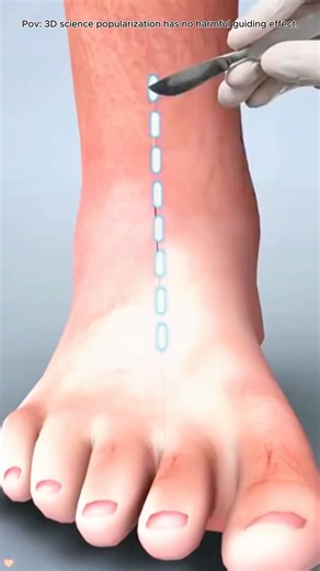 Ankle Replacement Surgery (3D Animation)#totalanklereplacement #anklearthritis #anklejointsurgery
