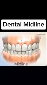 5.5K views · 28 reactions | Dental Midline is the line between your top middle teeth and your bottom middle teeth. #fbreelsfypシ゚viralfbreelsfypシ゚viral #fbreelsfypシ゚viralシ #fbreels2024 #irumadentalclinic #docanneirumalinto #0ralhealthmatters #oralknowledge #oralhealth #teeth #teethcare #dental #dentalcare #dentalknowledge #highlights #everyone #dentalawareness | Iruma Dental Clinic | Facebook