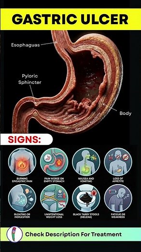 Gastric Ulcer Symptoms Most People Miss Until It’s Too Late