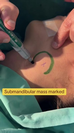 Understanding Submandibular Mass Diagnosis and Treatment