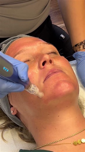 OUR $350 MICRONEEDLING TREATMENT FOR FREE?! HERE'S HOW! #microneedling #skincare #injection