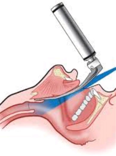 Direct Laryngoscopy: Mastering Biomechanical Intubation Techniques
