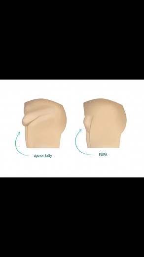 Understanding Apron Belly: Types, Causes, and Solutions