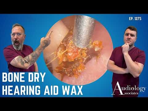Hearing Aid Wax So Dry It Shattered – Layers of Crumbling Skin Peeled Away – EP1275