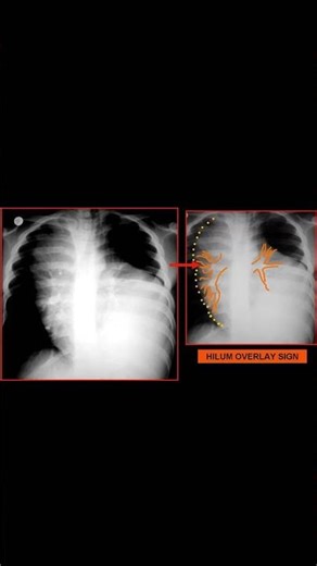 Hilum Overlay Sign Chest X-ray Explained #shorts