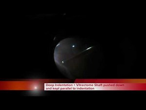 How to perform a complete vitrectomy in a phakic eye with retinal detachment