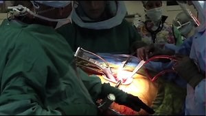 ANTERIOR ADVANTAGE™ Broaching Tips with the CORAIL® Hip Stem