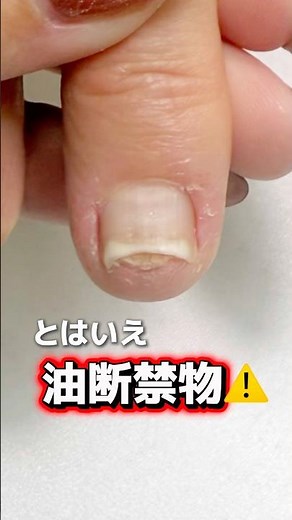 剥離爪の経過 #トラブル爪 #ネイル #深爪 #深爪矯正 #自爪育成 #爪甲剥離