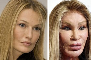 10 Celebs Who Ruined Their Faces Through Plastic Surgery
