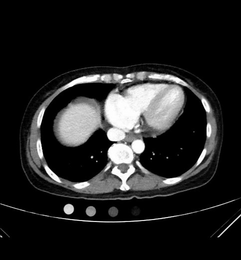 Blader Rupture CT Axial Annotated JETem 2021