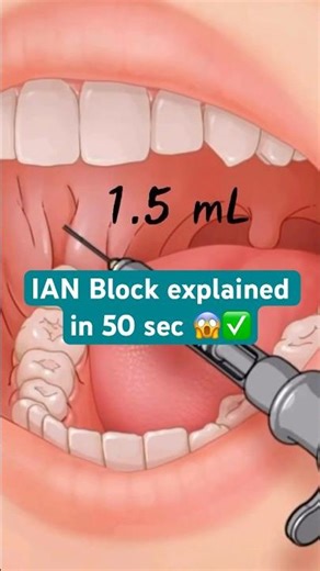 IAN Block explained in 50 sec 😱 #dental #viralvideo #dentalshorts #viral #ytshorts #dentistrytips