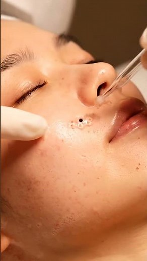 ASMR Cheek Blackhead Extraction | Gentle Deep Pore Cleansing & Glowing Skin Finish ✨