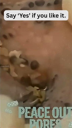 🔥Deep Blackheads, Milia & Whitehead Removal pimple popping New| Big Cystic Acne Extraction#1288 2026