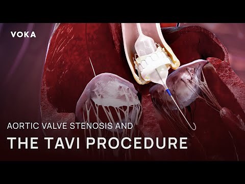How does TAVI procedure treat aortic valve stenosis?