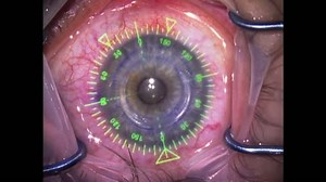 Intracorneal Ring Segments Using Verion system - Eyetube