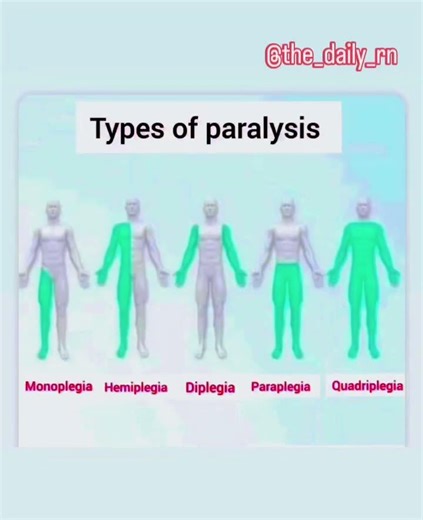 Types of paralysis