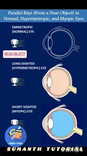 MYOPIA AND HYPERMETROPIA #CORRECTION IN EYE #SUMANTH TUTORIAL #PHYSICS #OPTICS #LIGHT #HUMAN EYE