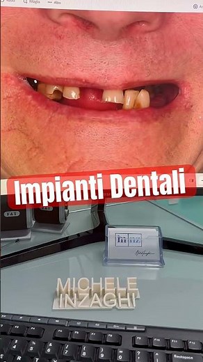 Torna a Sorridere con l’implantologia a carico immediato. Denti fissi in 5 ore con ZERO DOLORE!