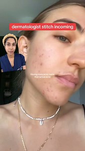 298K views · 3.8K reactions | Comment “ACNE MARKS” and I will DM you a list of the best products to fade each type of acne mark at home. Thanks juliavocadotoast for sharing your skin! #acnemarks #postinflammatoryerythema #acnescars #fyp | Dr. Neera | Facebook