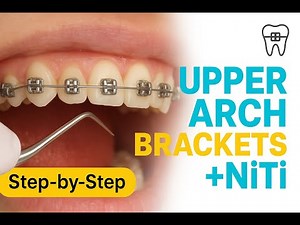 Step-by-Step Bracket Placement on 0.12 NiTi Wire | Complete Guide for Dentists & Orthodontists