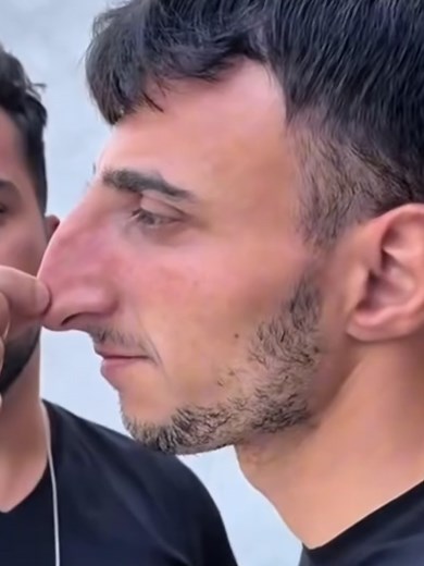 before and after Rhinoplasty #nosejob #rhinoplasty | nose