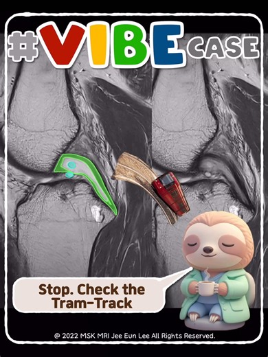 MSKMRI on Instagram: "📘 The Easiest Way to Avoid Misdiagnosing a PCL Tear How the “Tram-Track Appearance” Reveals Mucoid Degeneration — Not a Tear ✅ More structured MSK MRI guidance is available in my book, Visualizing MSK Radiology: A Practical Guide to Radiology Mastery on Amazon. https://www.amazon.com/dp/B0DJGMHMFS 1. What Is the Tram-Track Appearance? A classic MRI pattern of PCL mucoid degeneration, analogous to the ACL “celery-stalk sign.” MRI features: • Central homogeneous high signal