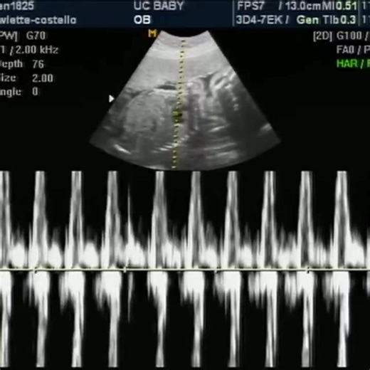 WOW! Listen to the sound of an unborn baby's beating heart. | LifeNews.com